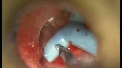 Tympanostomy T-Tube Insertion