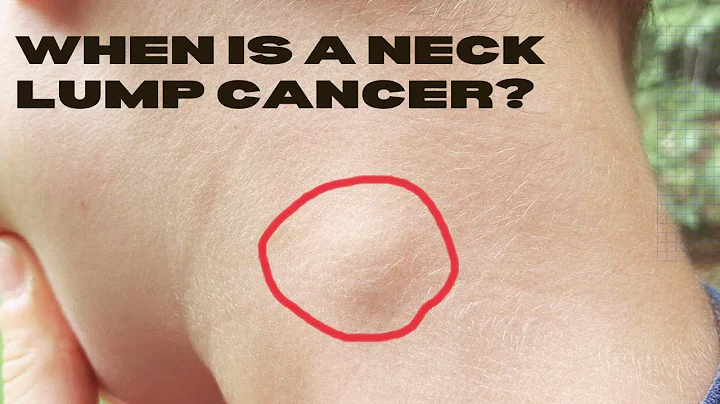 Could My Neck Lump Be Cancer Such as Lymphoma? - DayDayNews