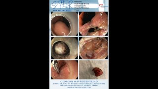 Rectal STER for GIST. Mavrogenis et al. Endoscopy 2023.
STER for a rectal GIST Rectal STER for GIST. Mavrogenis et al. Endoscopy 2023.