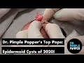 Dr. Pimple Popper's Top Pops of 2020: Epidermoid Cysts!