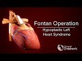 Ref:hIpvCUwml3c Medical animation: fontan operation cincinnati children's