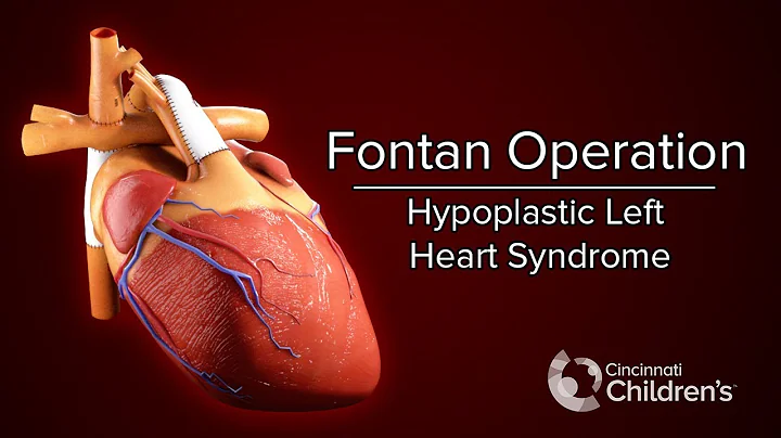 Medical Animation: Fontan Operation | Cincinnati C...