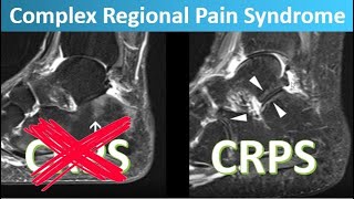 MRI in CRPS of the foot