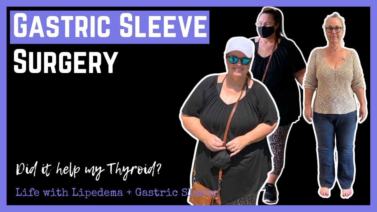Does Gastric Sleeve VSG Surgery work for Hypothyroidism or Hashimoto