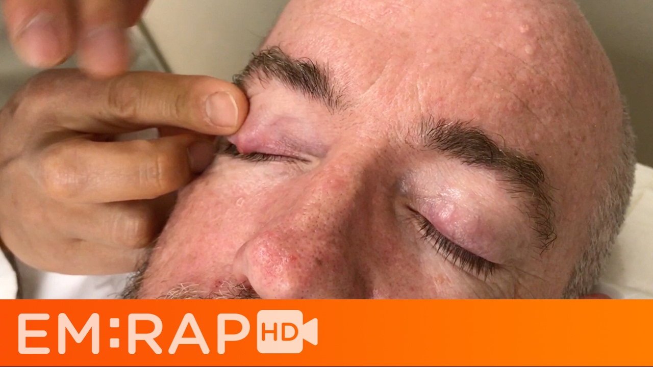 Chalazion Injection - Youtube