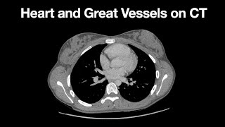 Anatomy of the Heart and Great Vessels on CT