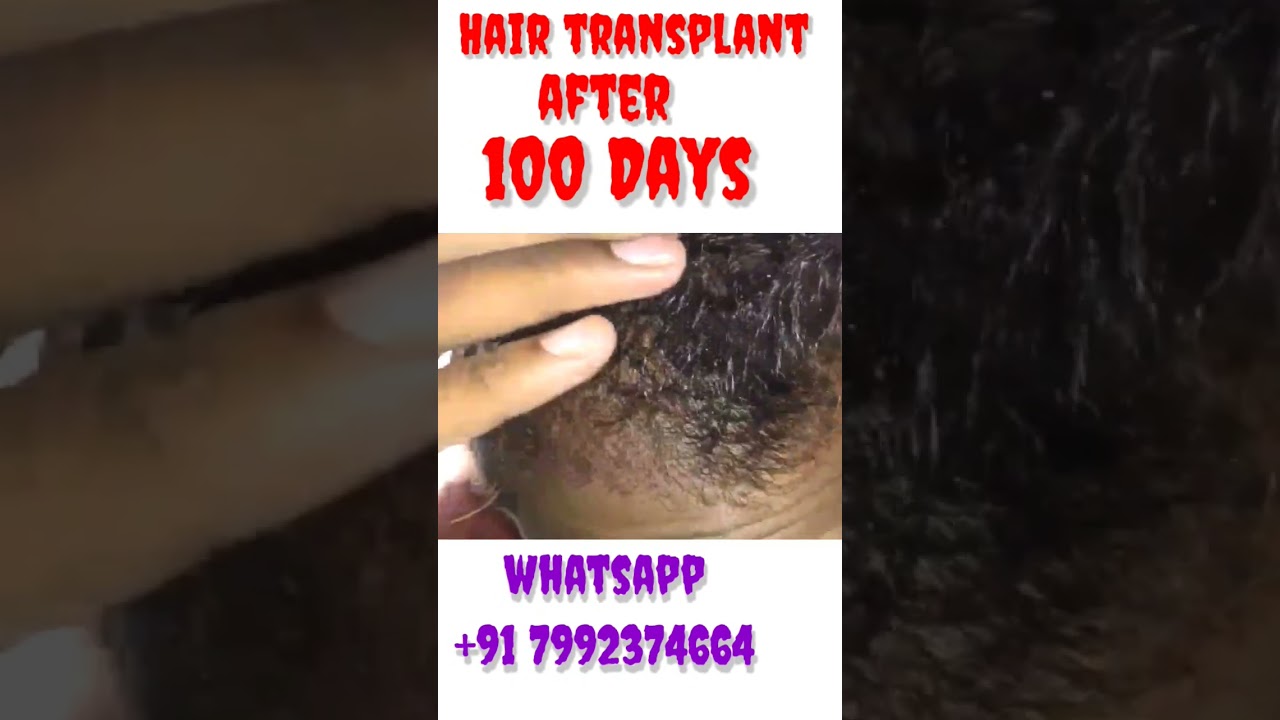 Hair Transplant - 3 Months Result 