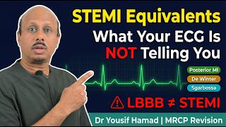 STEMI Equivalents Explained: Posterior MI, De Winter, Sgarbossa & Wellens | MRCP
