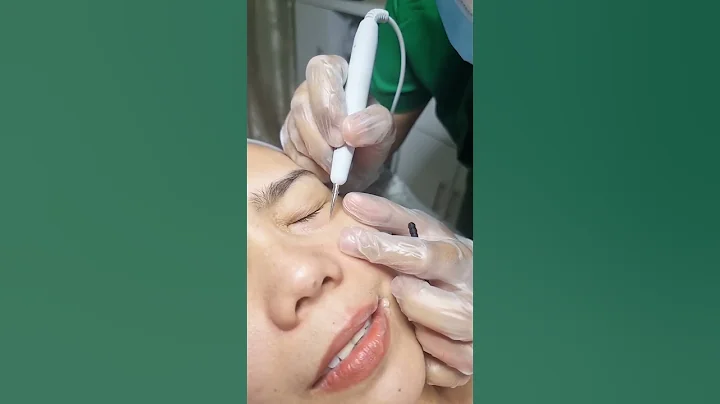 Intense Warts Removal | #shorts #aestheticclinic #howtomanagewarts