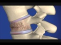Kyphoplasty Spinal Fracture Repair for Osteoporosis | Fox 43 FYI