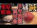 【吸い玉 肩甲骨はがし】吸い玉初体験 肩甲骨はがしキングの8年ぶりの施術 瘀血がヤバかった 自宅でできる方法も伝授 【横浜元町 銀座日本橋 鍼灸院】