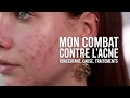 MON COMBAT CONTRE L'ACNÉ (CAUSE, TRAITEMENTS & MON AVIS SUR ROACCUTANE)