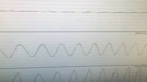 Minnesota Concussion Help- Vertical Smooth pursuit testing