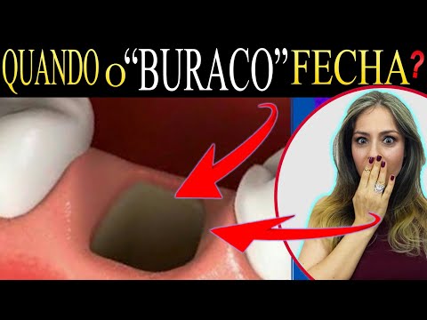 Vídeo: Como remover alimentos das cavidades dos dentes do siso extraídas: 14 etapas