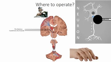 DBS for ET - an introduction