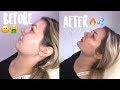 ENTIRE FACE OF FILLER EXPERIENCE 1ST TIME EVER !!- CHEEKS, CHIN, JAW, LIPS