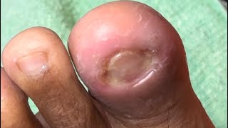 Ep_6099 Ingrown toenail removal  สงสารจังนิ้วน้องเล็กๆ ยังเป็นเล็บขบ  (clip from Thailand)
