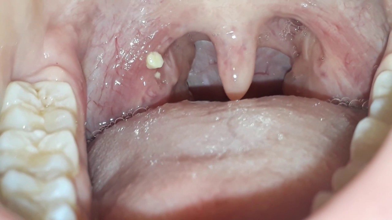 Tonsil Stones Removal Youtube