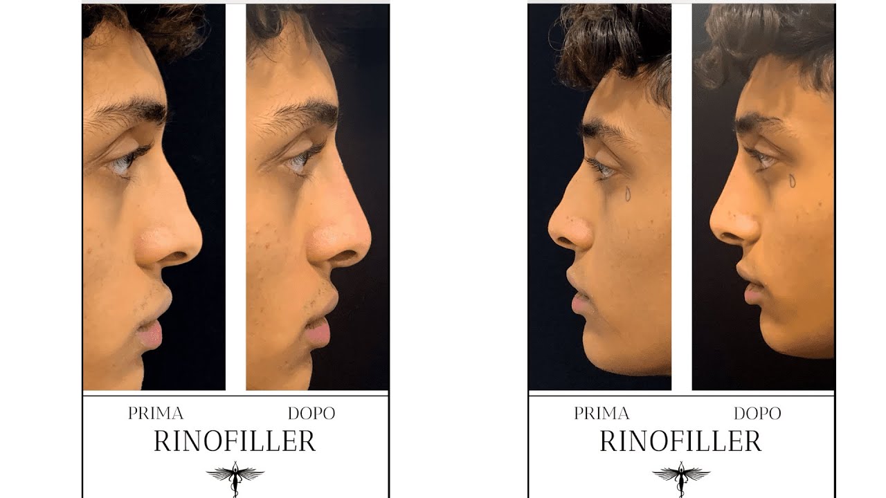 Rinofiller Naso Uomo Ecco Come Si Trasforma Senza Intervento YouTube