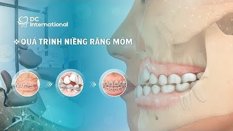 Quá Trình Niềng Răng Móm( Niềng Răng Khớp Cắn Ngược) Dr Cường