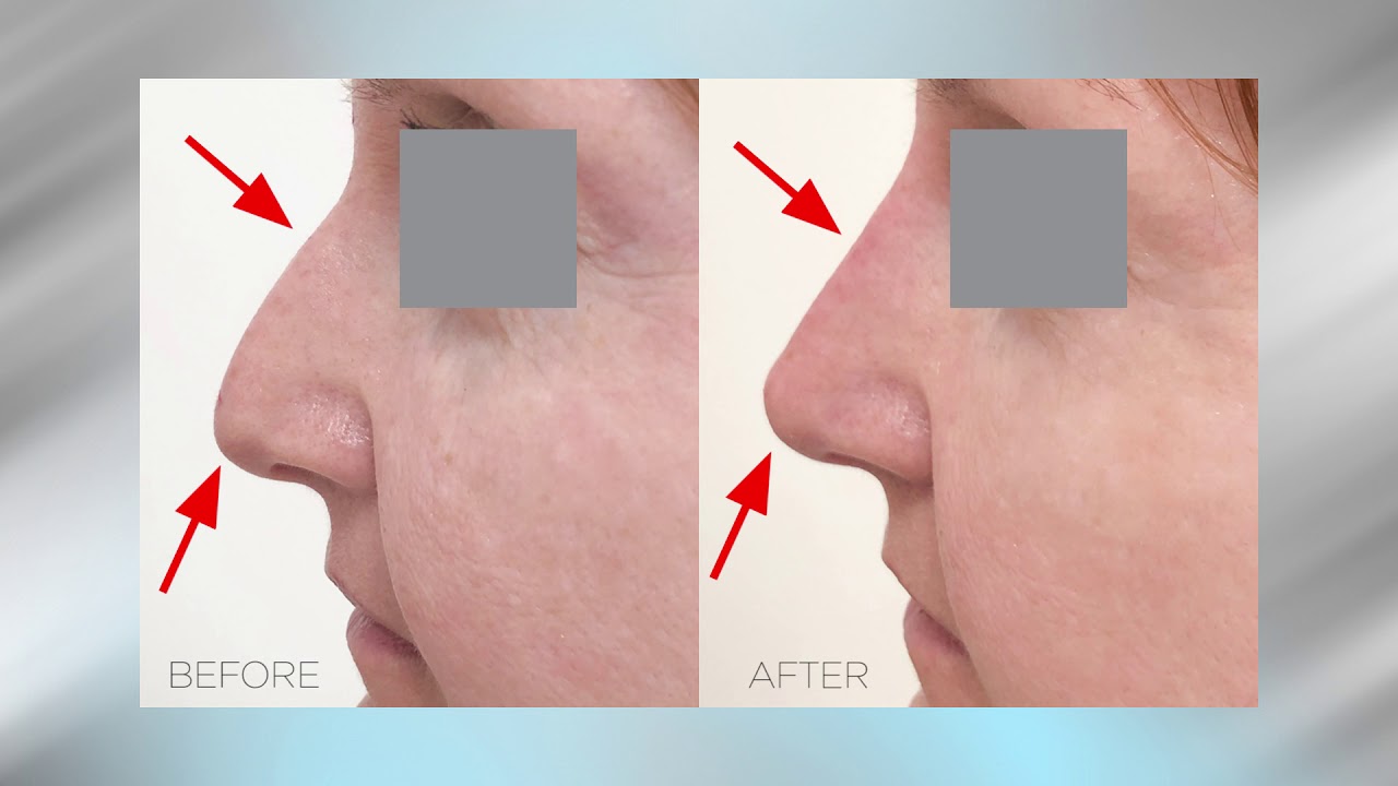 Nonsurgical nose job. Nose Juvederm filler performed