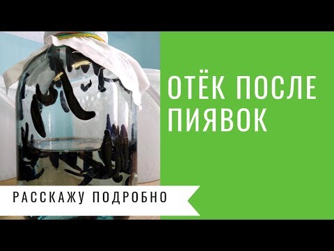 Побочные эффекты от гирудотерапии