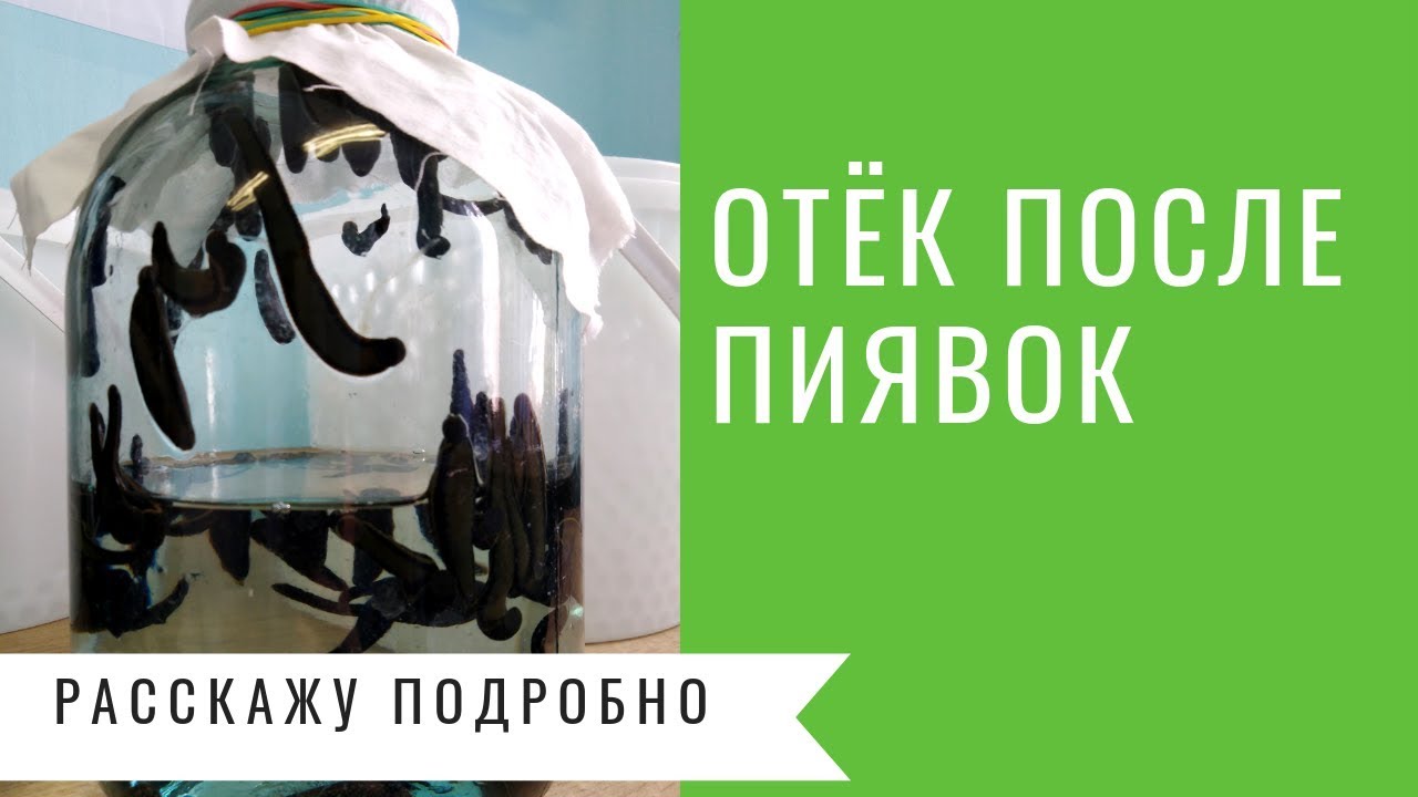 Побочные эффекты от гирудотерапии - YouTube