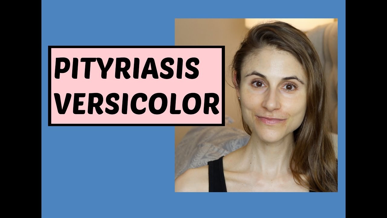 dr dray clinic Pityriasis (Tinea) versicolor: Q&A with dermatologist Dr Dray