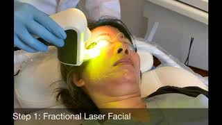 Rejuv Laser Facial - Advanced Rejuvenation Pigment