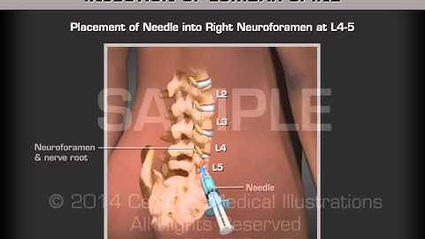 Lumbar Transforaminal Epidural Injection
