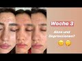 Akne und DEPRESSIONEN? - Aknenormin Therapie Videotagebuch 📔♥️ - Woche 3