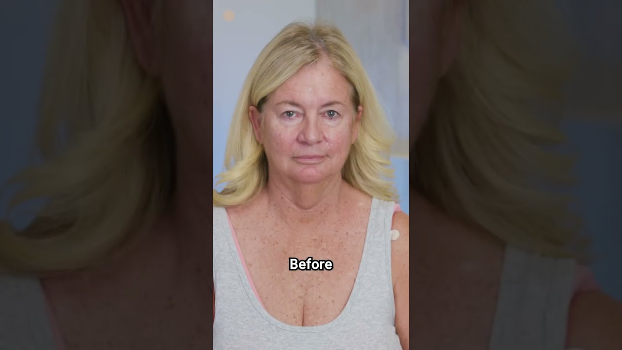 Best Deep Plane Facelift Results Deepplanefacelift Cosmeticsurgery