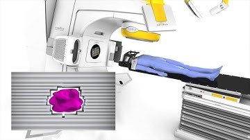 What is stereotactic radiosurgery? with Dr. Andrew See