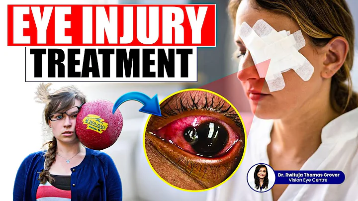 How to Treat Injured Eye | Eye Injury Treatment