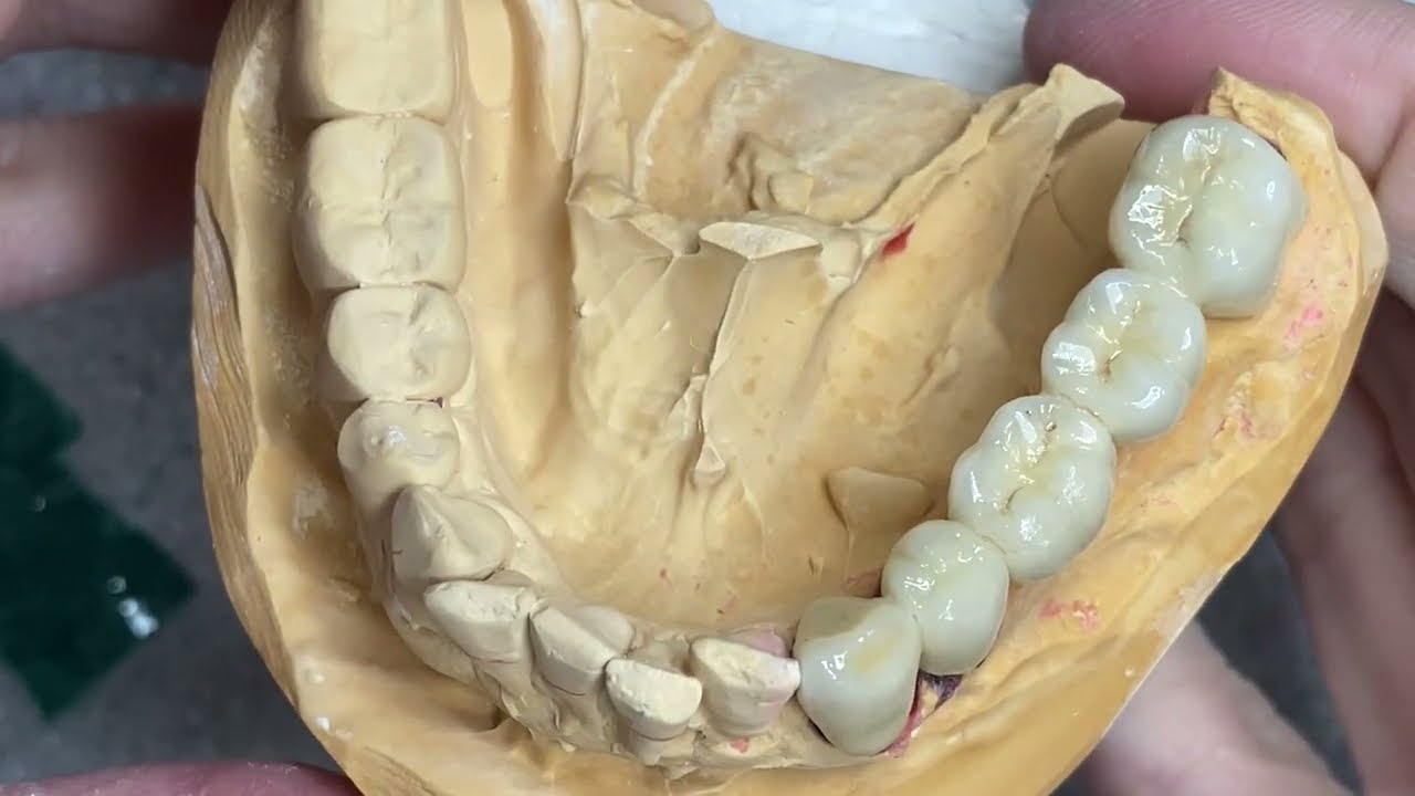 How to Make Lower Posterior Bridge 5 Unit Simple Buildup