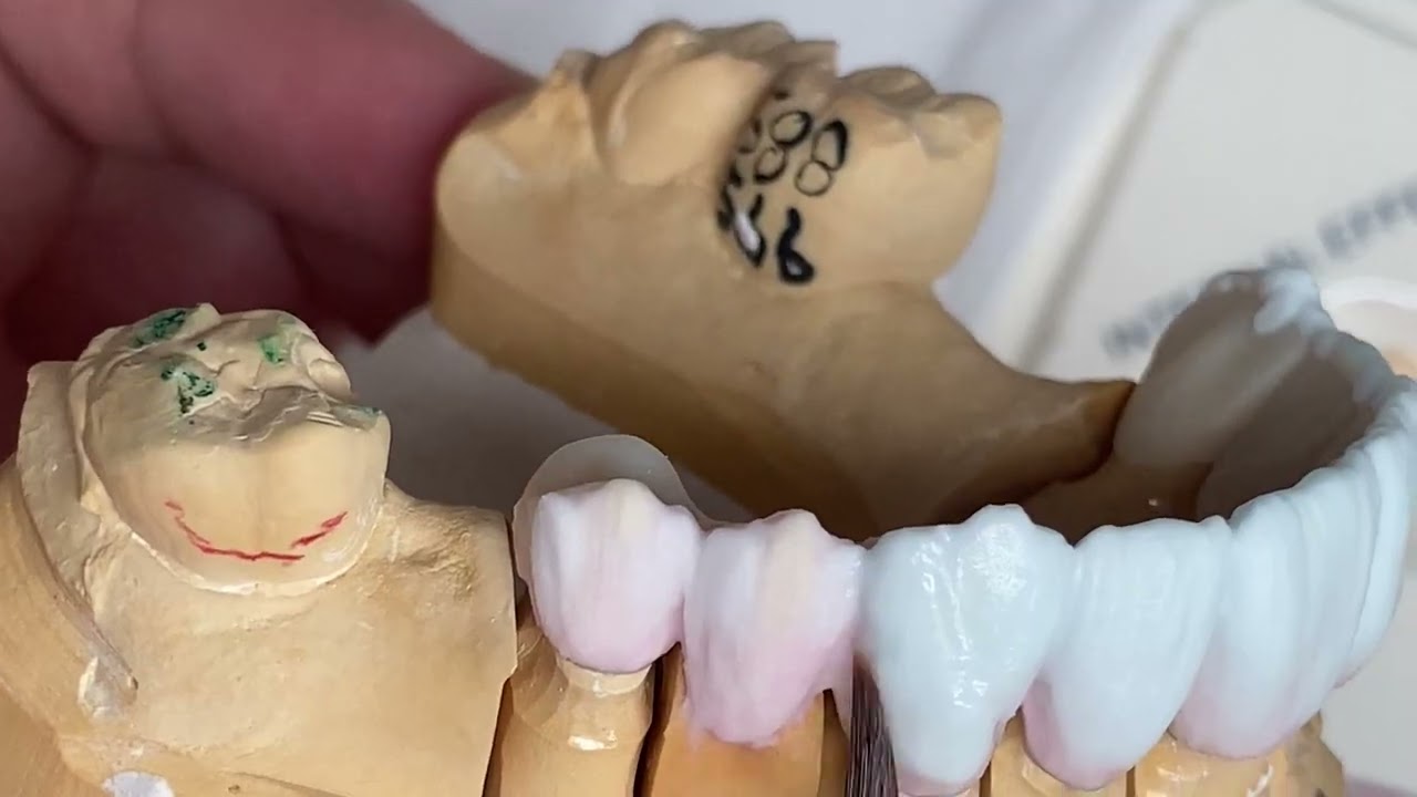 Как сделать коронку и мост из 8-секционного фарфора из диоксида циркония Vita