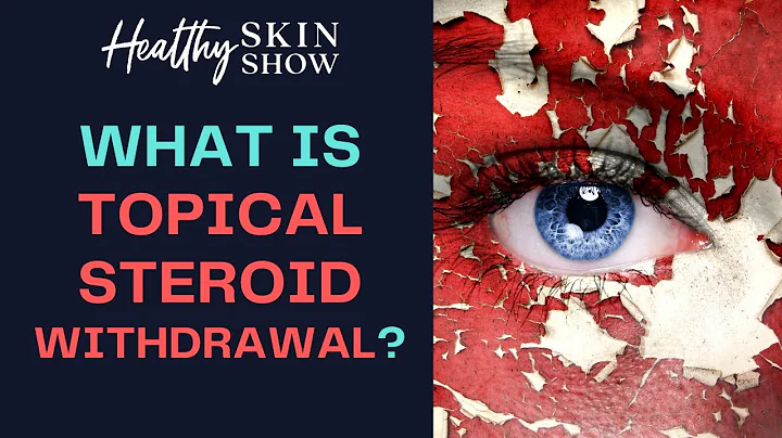 What Is TOPICAL STEROID WITHDRAWAL? | Kathryn Tullos