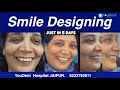 SMILE DESIGNING | ZIRCONIA CAP |EMAX CAPS |BEST SMILE DESIGNING CENTRE IN INDIA |YOUDENT JAIPUR I