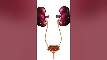 Biến chứng do sỏi niệu quản cần cảnh giác #shorts