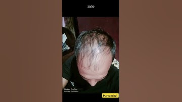 Traya hair regrowth 5 month review #hairgrowth #explorepage #natural #skincare #hairstyle #organic