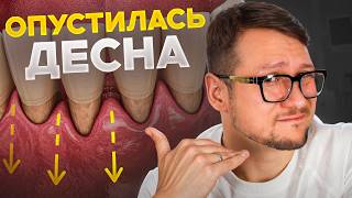 Опустилась десна? ЧТО ДЕЛАТЬ? / Рецессия десны / Причины, лечение и профилактика