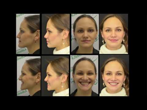 Video: Natalia Vid Kirurgavtal På Face Smile Center