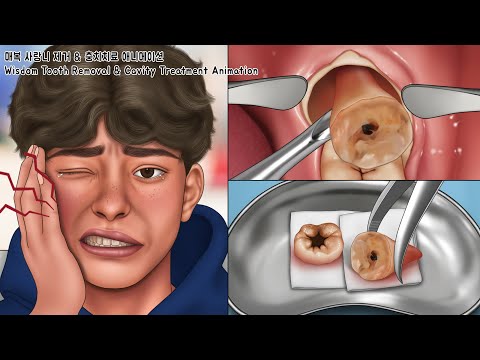 ASMR 매복 사랑니 제거 & 충치치료 풀버전! | 치아미백 | Wisdom Tooth & Cavity Treatment Animation