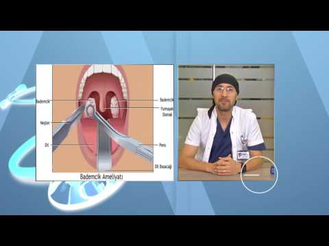 Video: Angina Ağrıları Nasıl Anlaşılır (Resimlerle)