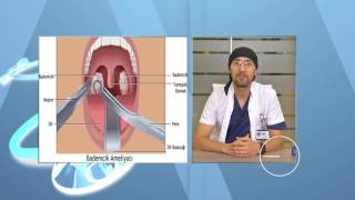 Bademcik İltihaplanması Belirtileri Ve Tedavisi Bademcik Ameliyatı Nasıl Yapılır?