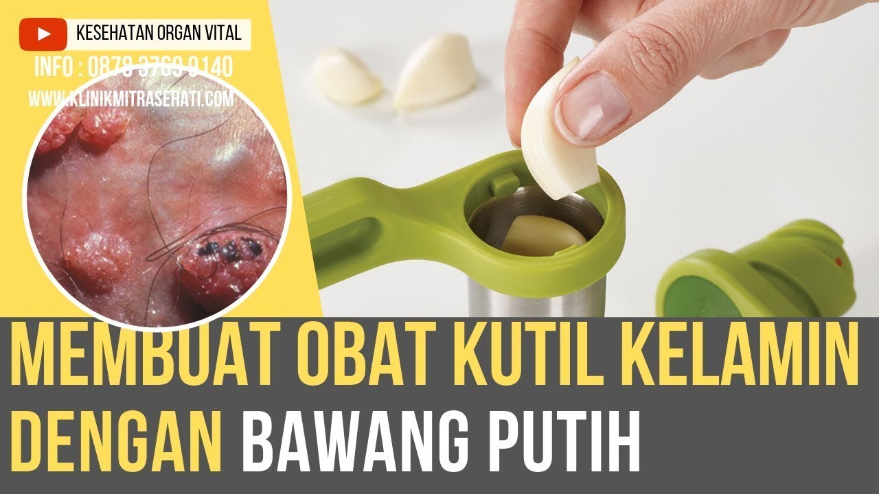 Cara Menyembuhkan Kutil Kelamin Dengan Bumbu Dapur Bawang Putih 