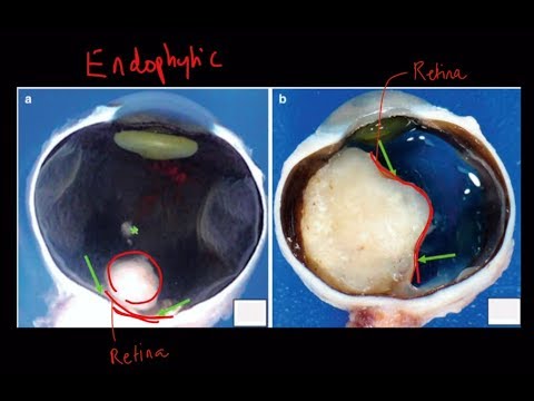 Video: Onkogenlar retinoblastoma neoplastik hujayralarining o'sishini rag'batlantiradi