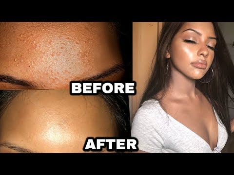 SECRET TO CLEARING TINY FOREHEAD BUMPS!