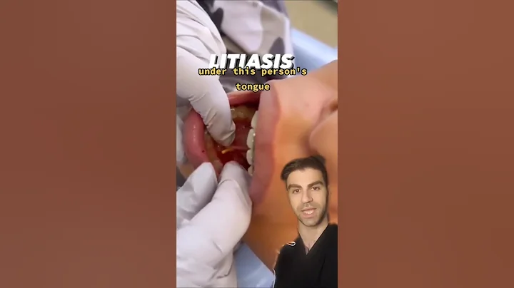 Salivary Gland Stone Removal