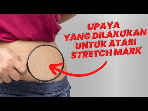 Video: 5 Cara Mencegah Stretch Mark